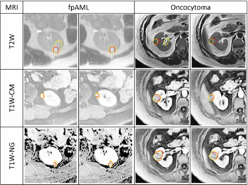 Fully Automated Deep Learning-Based Renal Mass Detection on Multi-Parametric MRI