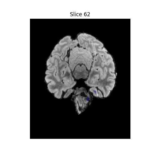 Brain tumor slices animation