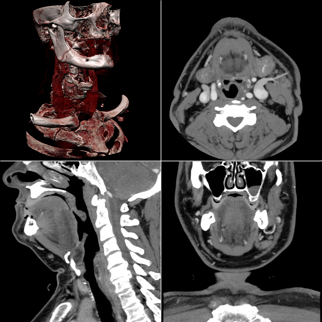 CT scan neck visualization